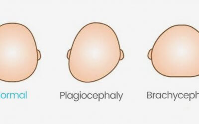 Plagiocéphalie du nourrisson : tout comprendre sur la tête plate de bébé
